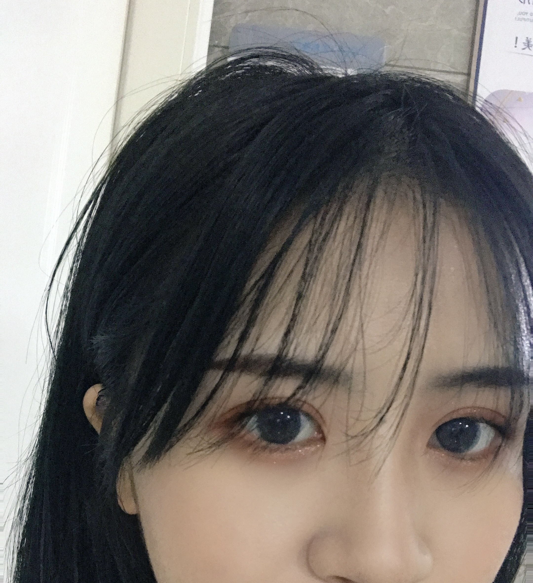 双眼皮手术