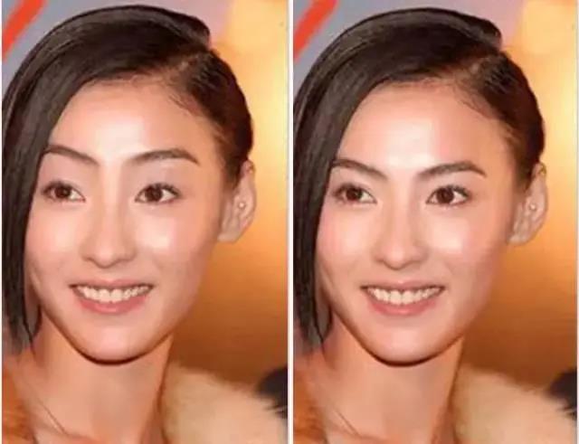 双眼皮手术