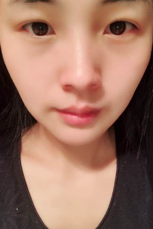 【去眼袋手术】不动刀清理掉的眼袋居然也能不564