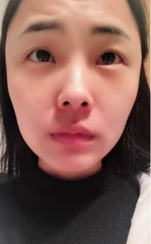【去眼袋手术】不动刀清理掉的眼袋居然也能不564