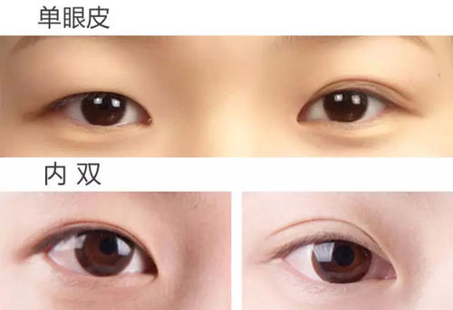 双眼皮手术
