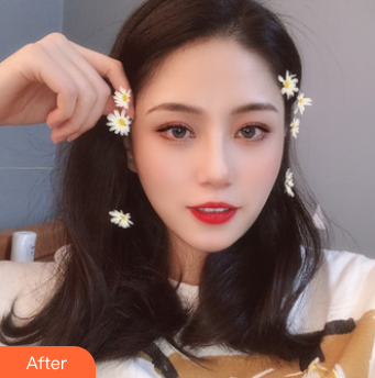 双眼皮手术