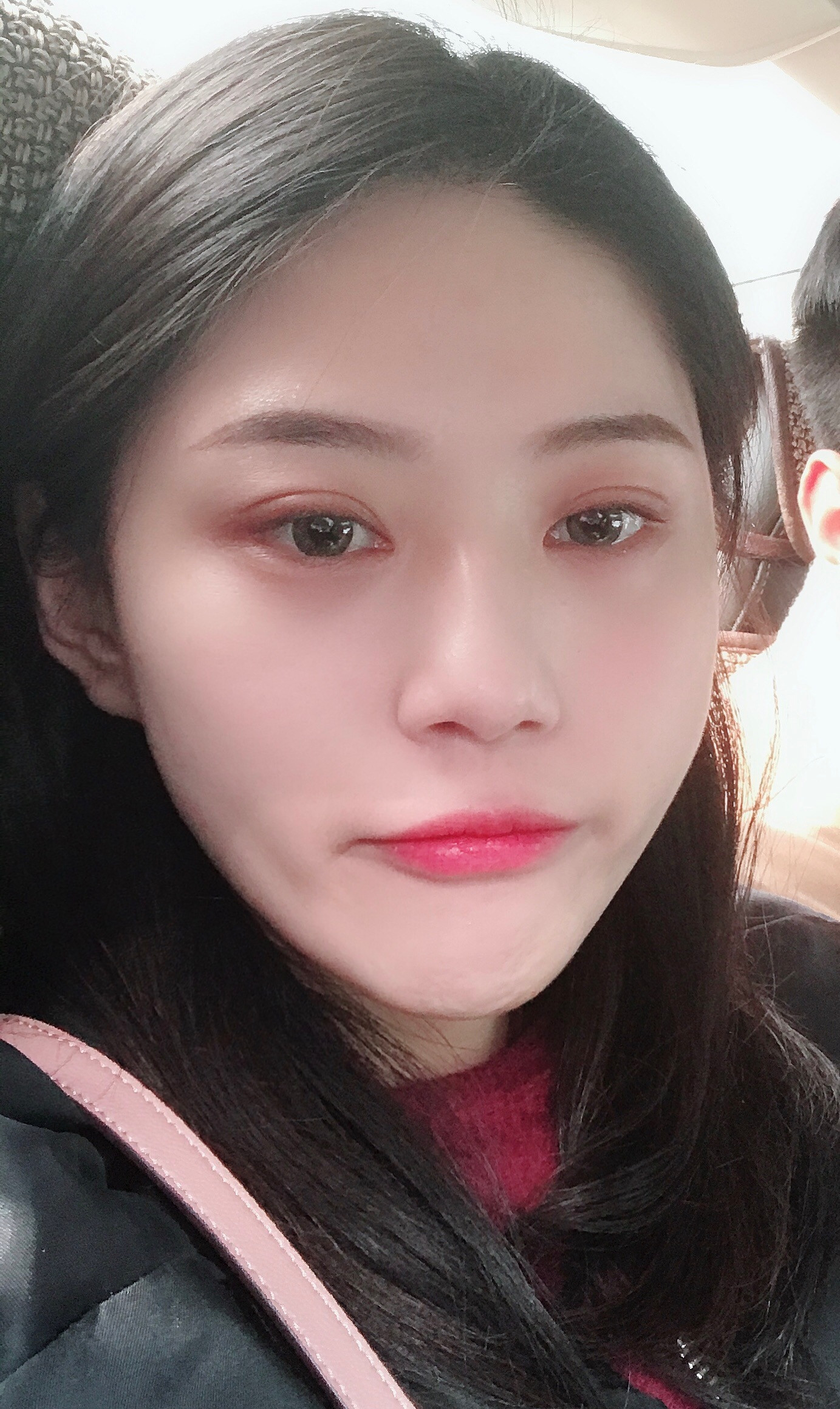 去眼袋手术