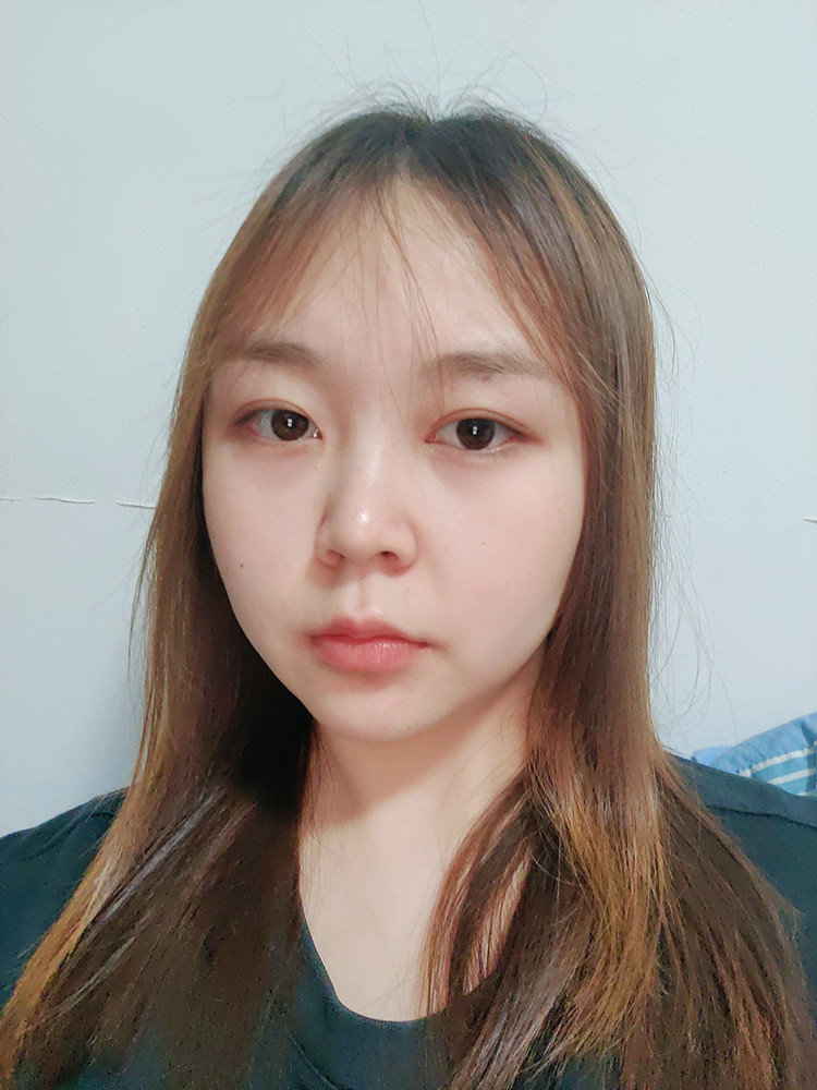 双眼皮手术