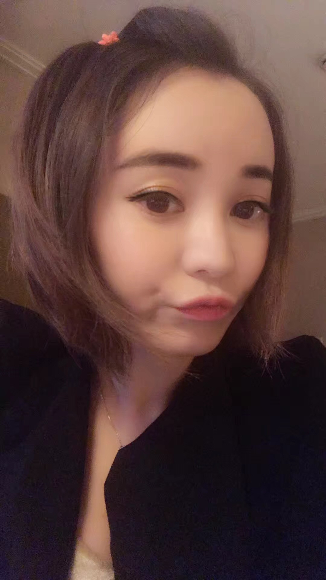 双眼皮手术