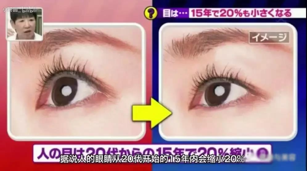 双眼皮手术