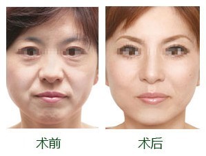 去眼袋手术