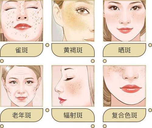 祛斑手术哪家强?超皮秒祛斑管用吗?327 祛斑手术哪家强?超皮秒祛斑管用吗?327