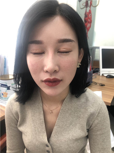 双眼 皮手术后眼部形态不好看怎么办?来看双眼 双眼 皮手术后眼部形态不好看怎么办?来看双眼
