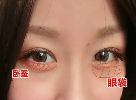 【去眼袋手术】别再顶着大眼袋熬夜追剧啦~ 【去眼袋手术】别再顶着大眼袋熬夜追剧啦~