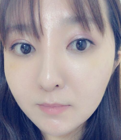 【去眼袋手术】别再顶着大眼袋熬夜追剧啦~ 【去眼袋手术】别再顶着大眼袋熬夜追剧啦~