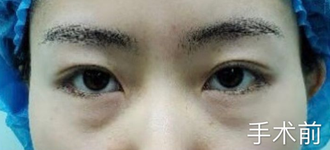 去眼袋有捷径可走吗?哪种去眼袋手术好用? 去眼袋有捷径可走吗?哪种去眼袋手术好用?