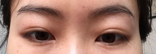 去眼袋有捷径可走吗?哪种去眼袋手术好用? 去眼袋有捷径可走吗?哪种去眼袋手术好用?