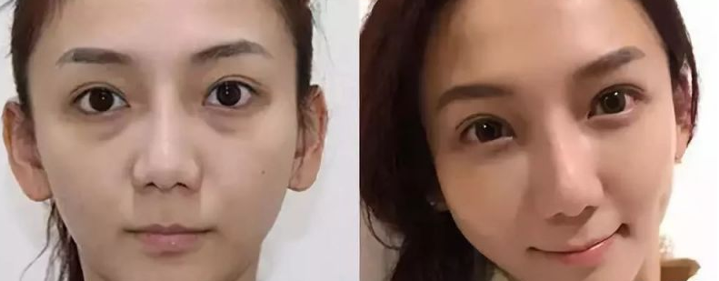 去眼袋手术:你得颜值距离“封神”,只有祛掉 去眼袋手术:你得颜值距离“封神”,只有祛掉
