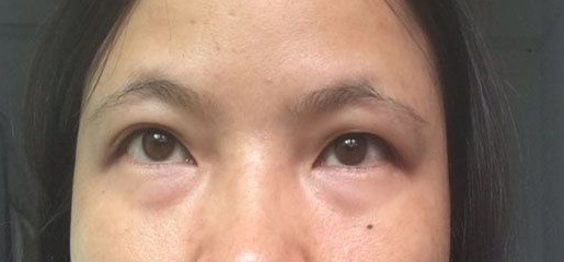 去眼袋手术:你得颜值距离“封神”,只有祛掉 去眼袋手术:你得颜值距离“封神”,只有祛掉