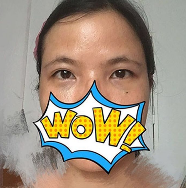 去眼袋手术:你得颜值距离“封神”,只有祛掉 去眼袋手术:你得颜值距离“封神”,只有祛掉