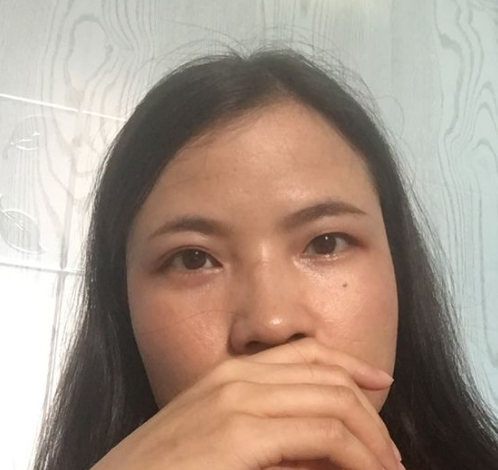 去眼袋手术:你得颜值距离“封神”,只有祛掉 去眼袋手术:你得颜值距离“封神”,只有祛掉