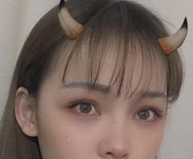 令人无法抗拒得眼周抗衰——不动刀去眼袋手术 令人无法抗拒得眼周抗衰——不动刀去眼袋手术