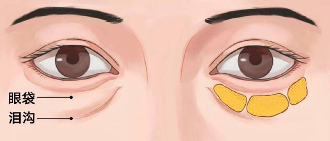 【去眼袋手术】眼袋那么大,用什么捷径解决? 【去眼袋手术】眼袋那么大,用什么捷径解决?