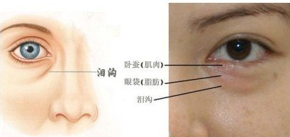 【去眼袋手术】眼袋那么大,用什么捷径解决? 【去眼袋手术】眼袋那么大,用什么捷径解决?