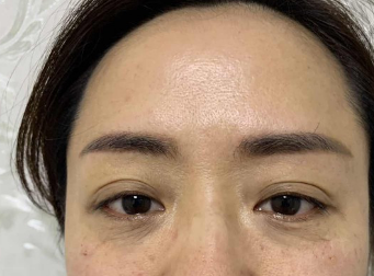 【去眼袋手术】眼袋那么大,用什么捷径解决? 【去眼袋手术】眼袋那么大,用什么捷径解决?
