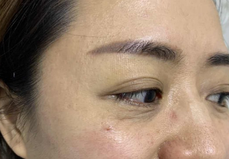 【去眼袋手术】眼袋那么大,用什么捷径解决? 【去眼袋手术】眼袋那么大,用什么捷径解决?