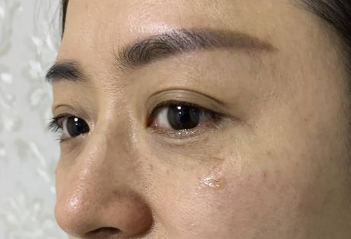 【去眼袋手术】眼袋那么大,用什么捷径解决? 【去眼袋手术】眼袋那么大,用什么捷径解决?