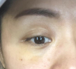 【去眼袋手术】眼袋那么大,用什么捷径解决? 【去眼袋手术】眼袋那么大,用什么捷径解决?