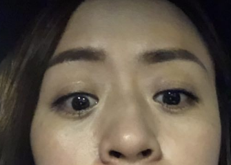 【去眼袋手术】眼袋那么大,用什么捷径解决? 【去眼袋手术】眼袋那么大,用什么捷径解决?
