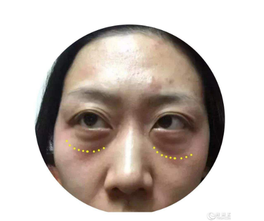 熬夜得大眼袋怎么补救?这款去眼袋手术备受好 熬夜得大眼袋怎么补救?这款去眼袋手术备受好