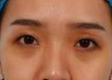 熬夜得大眼袋怎么补救?这款去眼袋手术备受好 熬夜得大眼袋怎么补救?这款去眼袋手术备受好