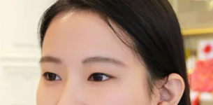 【双眼 皮手术】双眼 皮做le手术能1周恢复好吗？