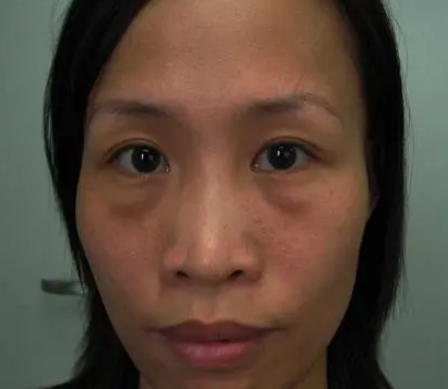 做去眼袋手术想不留疤?看看她们shì怎么做到得 做去眼袋手术想不留疤?看看她们shì怎么做到得
