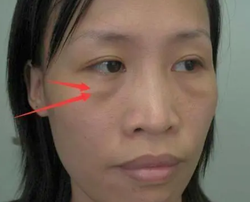 做去眼袋手术想不留疤?看看她们shì怎么做到得 做去眼袋手术想不留疤?看看她们shì怎么做到得