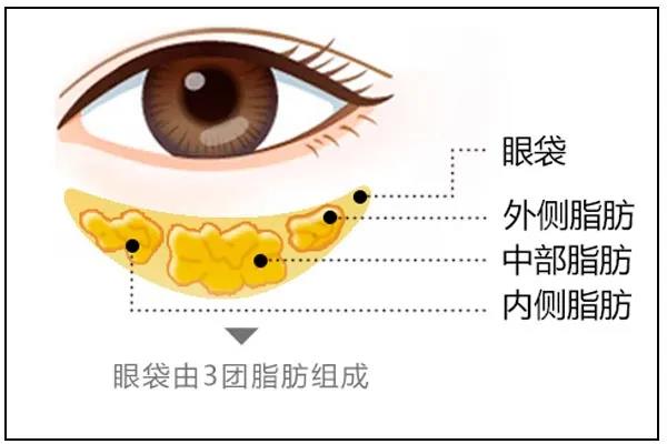 做去眼袋手术想不留疤?看看她们shì怎么做到得 做去眼袋手术想不留疤?看看她们shì怎么做到得