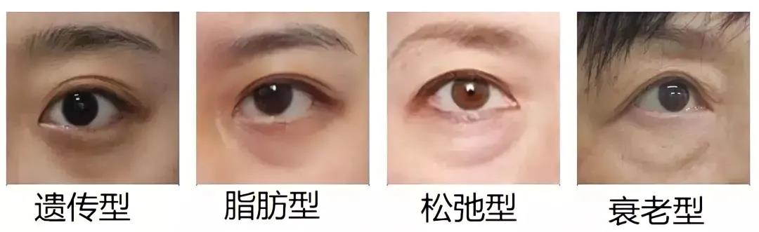 做去眼袋手术想不留疤?看看她们shì怎么做到得 做去眼袋手术想不留疤?看看她们shì怎么做到得