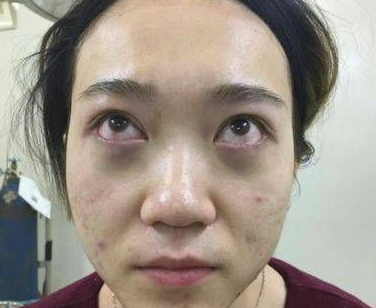 做去眼袋手术想不留疤?看看她们shì怎么做到得 做去眼袋手术想不留疤?看看她们shì怎么做到得