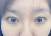 做去眼袋手术想不留疤?看看她们shì怎么做到得 做去眼袋手术想不留疤?看看她们shì怎么做到得