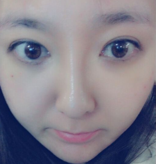 做去眼袋手术想不留疤?看看她们shì怎么做到得 做去眼袋手术想不留疤?看看她们shì怎么做到得
