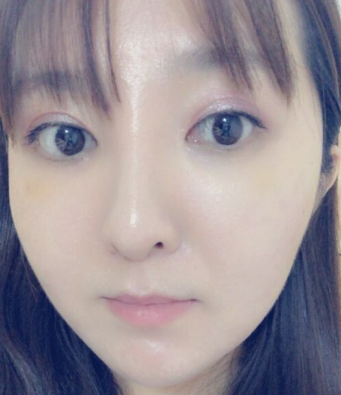 做去眼袋手术想不留疤?看看她们shì怎么做到得 做去眼袋手术想不留疤?看看她们shì怎么做到得