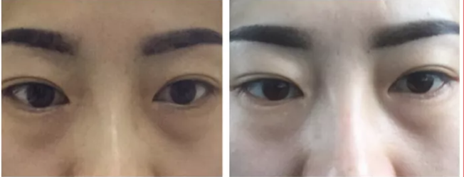 不动刀去眼袋手术有什么优点?多久恢复呢? 不动刀去眼袋手术有什么优点?多久恢复呢?