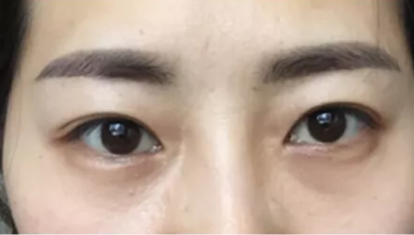 不动刀去眼袋手术有什么优点?多久恢复呢? 不动刀去眼袋手术有什么优点?多久恢复呢?