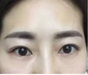 不动刀去眼袋手术有什么优点?多久恢复呢? 不动刀去眼袋手术有什么优点?多久恢复呢?