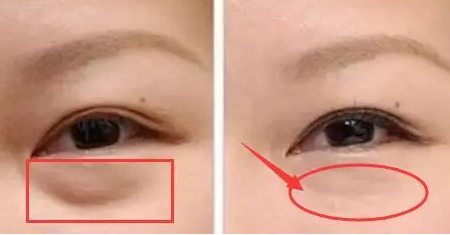 不动刀去眼袋手术有什么优点?多久恢复呢? 不动刀去眼袋手术有什么优点?多久恢复呢?