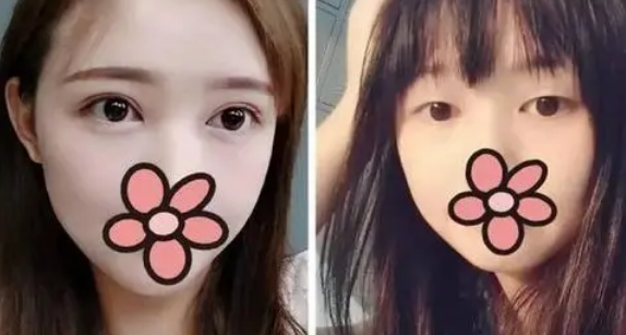 双眼皮手术