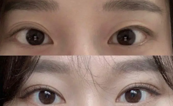 双眼皮手术