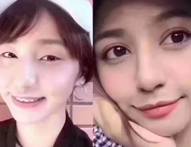 双眼皮手术