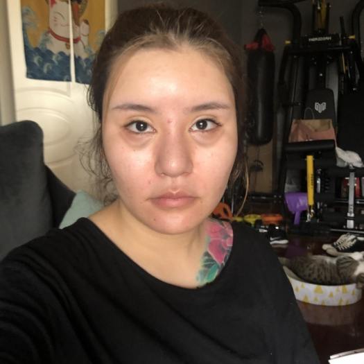 去眼袋手术反馈 - 观望这么久，她终于还是做了614