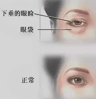 去眼袋手术反馈 - 观望这么久，她终于还是做了614
