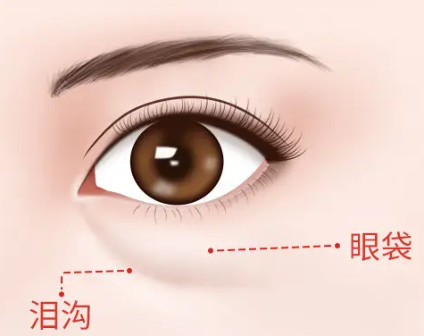 【去眼袋手术】眼袋膨出严重细纹滋长怎么办917 【去眼袋手术】眼袋膨出严重细纹滋长怎么办917